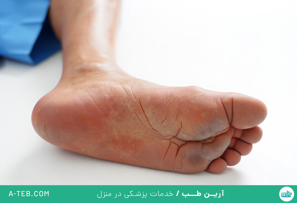 زخم پای دیابتی