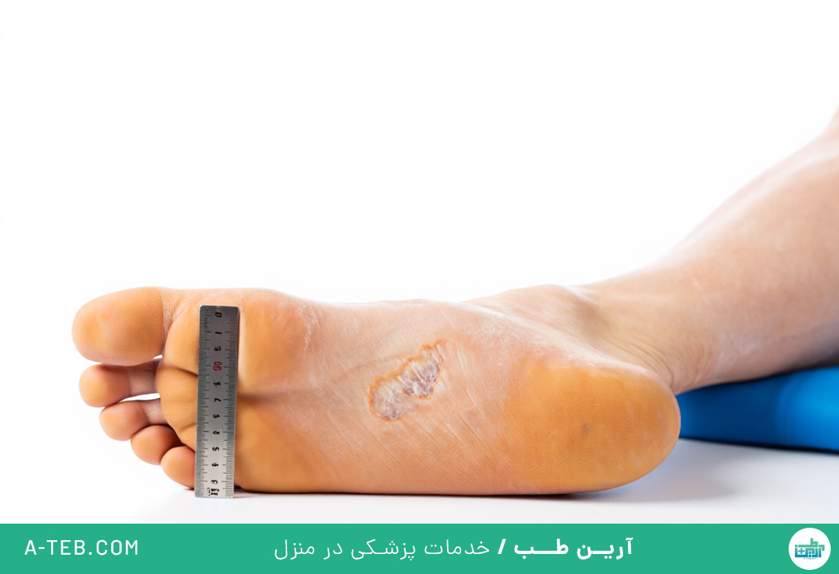 زخم پای دیابتی